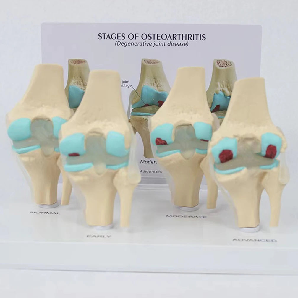 Anatomical Human Degenerative 4-stage Knee Joint Disease Model PVC Bone Medical Skeleton Anatomy Teaching Resources ﻿Wholesale