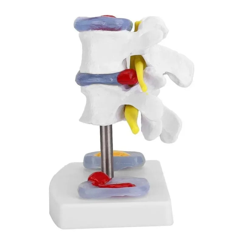1:1 Life size Anatomical Human Lumbar Disc Herniation Demonstration Spine Anatomy Model School Training Supplies