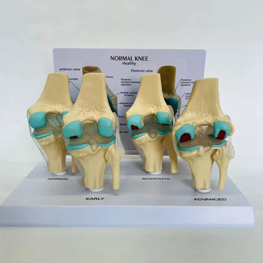 Anatomical Human Degenerative 4-stage Knee Joint Disease Model PVC Bone Medical Skeleton Anatomy Teaching Resources ﻿Wholesale