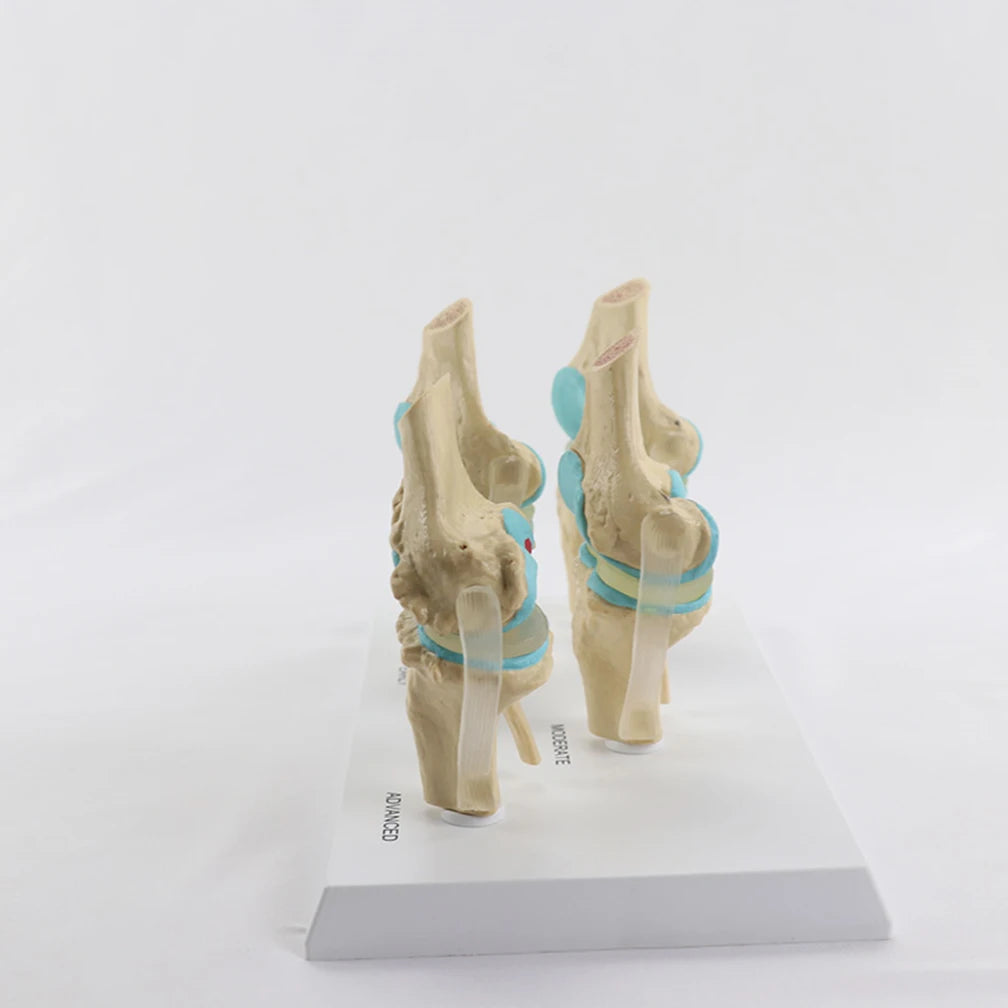 Anatomical Human Degenerative 4-stage Knee Joint Disease Model PVC Bone Medical Skeleton Anatomy Teaching Resources ﻿Wholesale