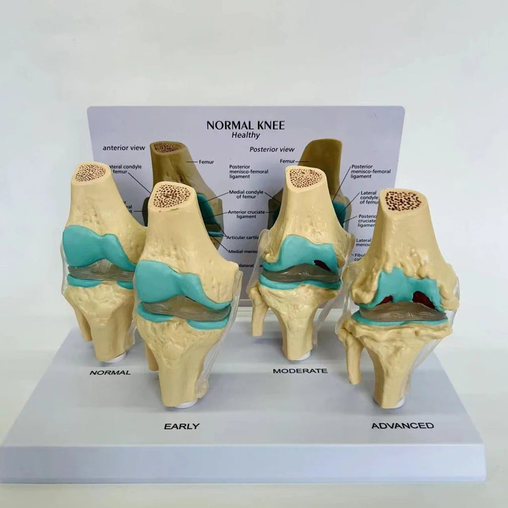 Anatomical Human Degenerative 4-stage Knee Joint Disease Model PVC Bone Medical Skeleton Anatomy Teaching Resources ﻿Wholesale