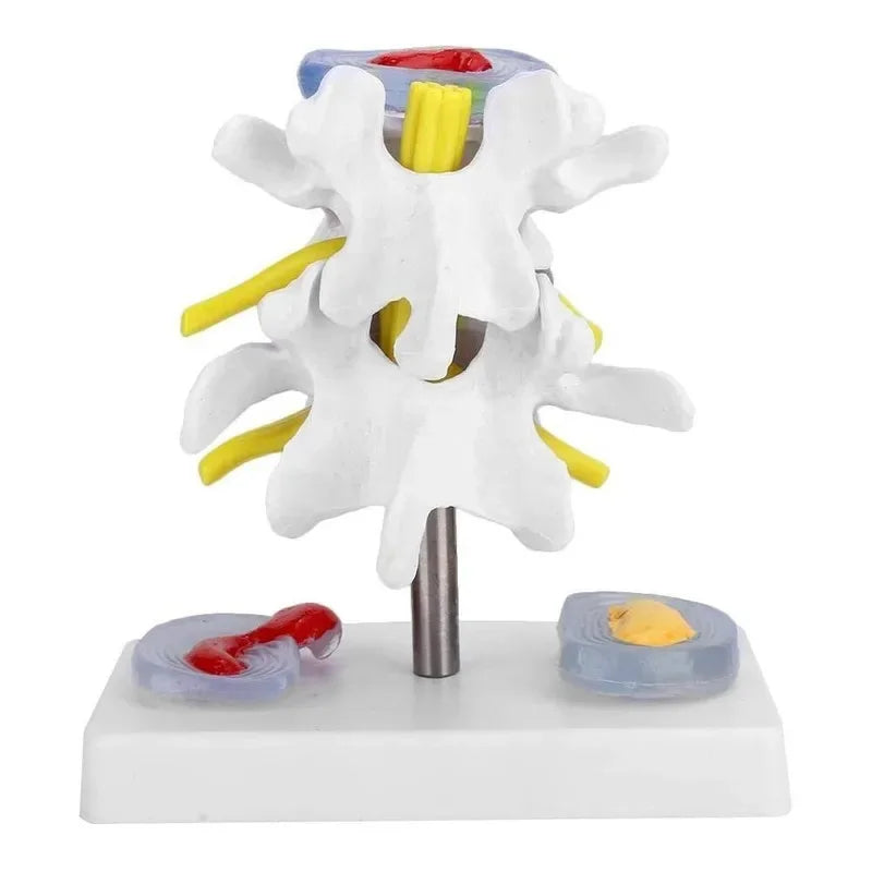 1:1 Life size Anatomical Human Lumbar Disc Herniation Demonstration Spine Anatomy Model School Training Supplies
